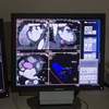 National Health Service Trials AI Software to Diagnose Breast Cancer