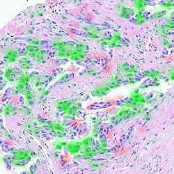 Locations in a scan of cancer cells where information was extracted (in red and green).