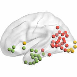 Each collection of colored dots represent clusters of brain regions that studies suggest might lead to impaired knowledge.