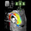AI Accelerates Blood Flow MRI