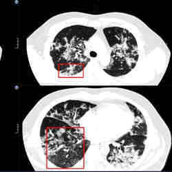 A scan of lung tissue. 