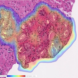 prostate biopsy with cancer heatmap