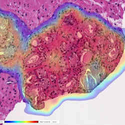 Portion of a prostate biopsy; red indicates high cancer probability, blue low probability.