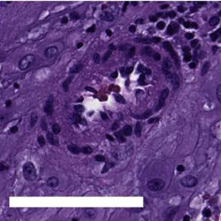 Image showing a decidual arteriole affected by decidual vasculopathy