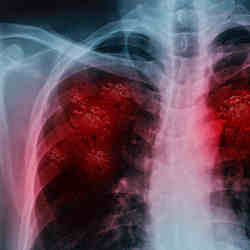 Finding coronavirus in the lungs. 