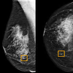 The yellow box indicates where an artificial intelligence system found cancer within breast tissue.
