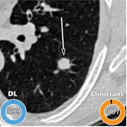 A lung nodule identified in a computed tomography scan. 