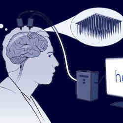 Two tiny arrays of implanted electrodes relayed information from the brain area that controls the hands and arms to an algorithm, which translated it into letters that appeared on a screen.