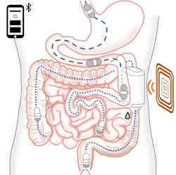 Diagram of how the insulin delivery system works.