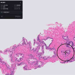 The Paige Prostate software is designed to identify areas in pathology images that may indicate prostate cancer.