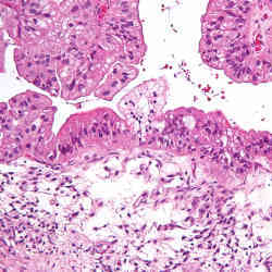 Ovarian cancer cells.