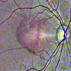 A graphical representation of the idea of using a scan of the eye to get a window into heart health.