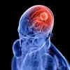 Scientists Diagnose Brain Tumors Using AI
