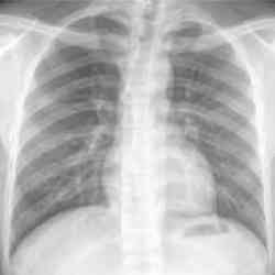 A normal chest x-ray.