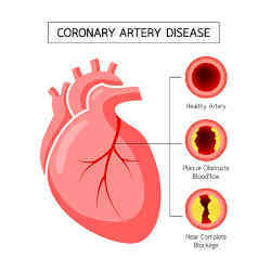 An visual explanation of coronary artery disease.