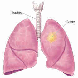 Lung cancer.