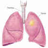 AI Model Can Detect Future Lung Cancer Risk
