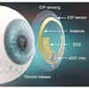 Smart Contact Lens Diagnoses, Treats Glaucoma