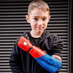 The prosthetic arm works with sensors to help the wearer do things like hold different items.
